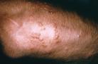 Allergic rection of poison ivy
